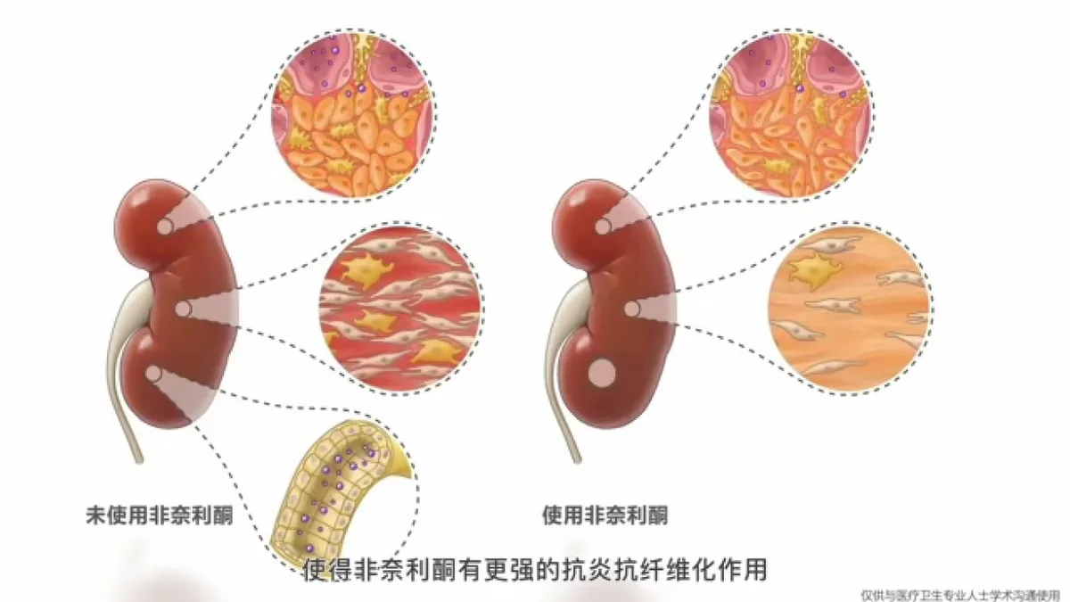 非奈利酮与糖尿病肾病